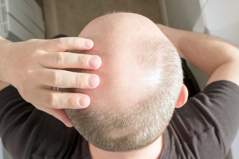 Scalp micropigmentation for pattern baldness