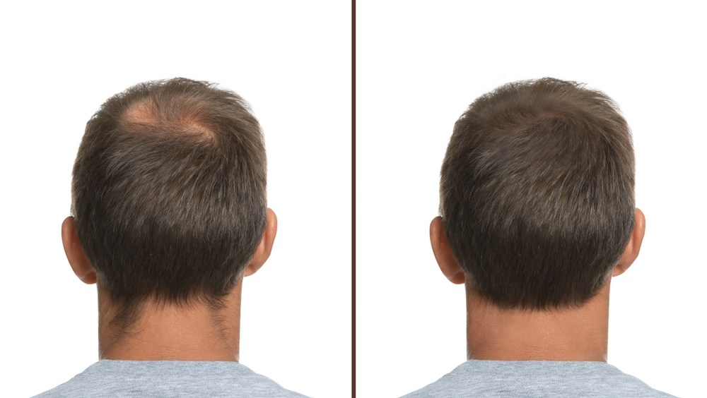 Crown before and after scalp micropigmentation density