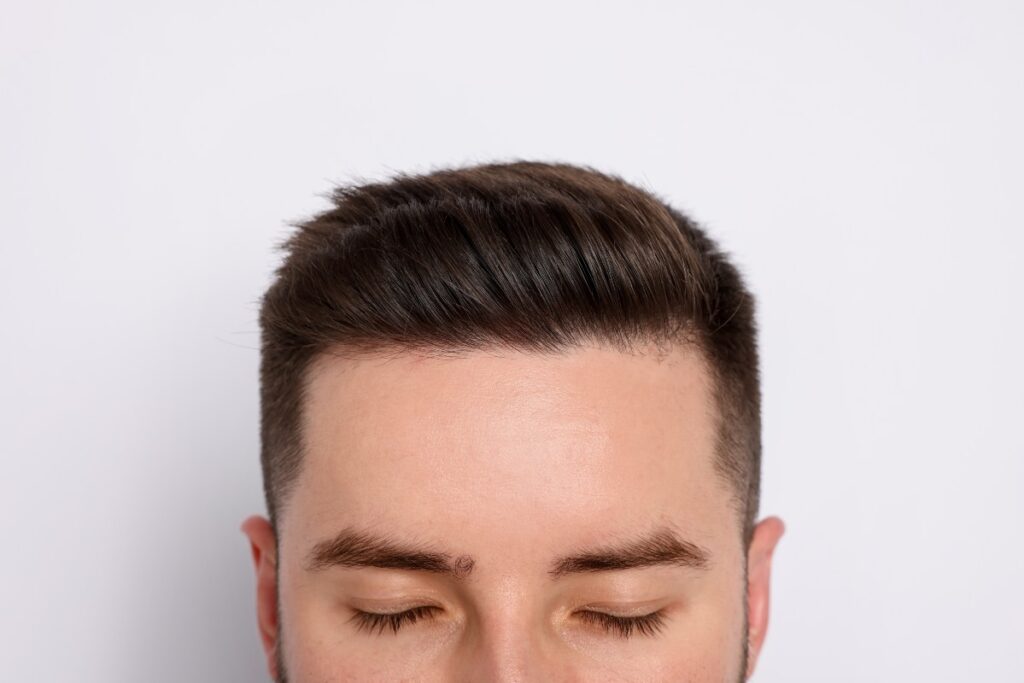 Scalp micropigmentation receding hairline