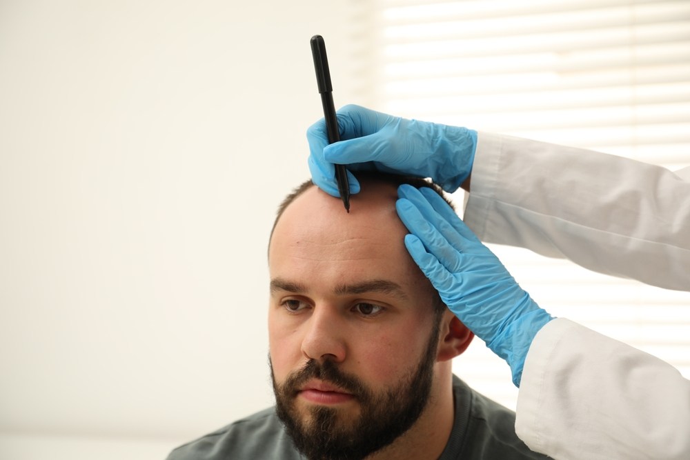 Specialist performing scalp micropigmentation