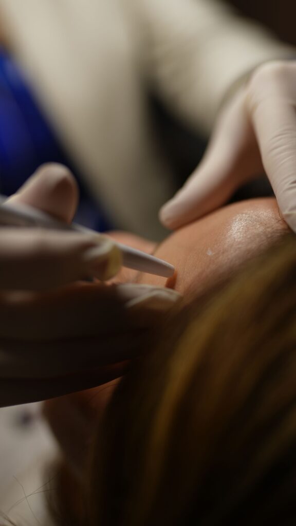Dermaplaning treatment
