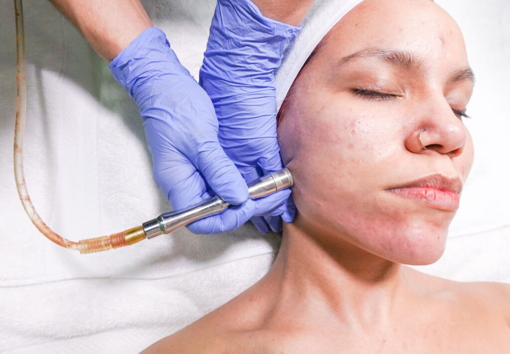 SQT Bio Microneedling course of treatments